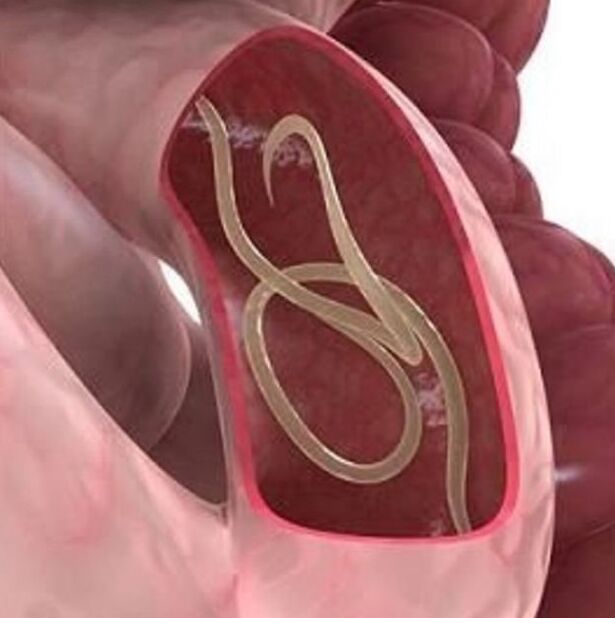 Sinais de vermes em uma pessoa no trato gastrointestinal